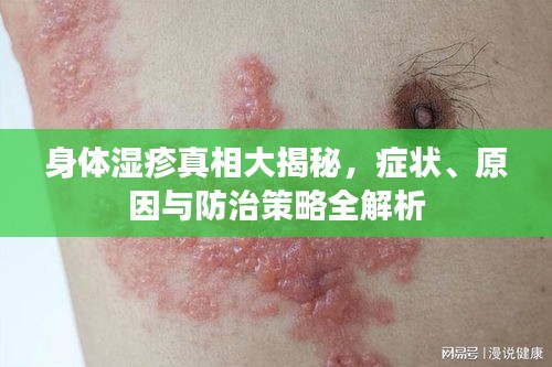 身体湿疹真相大揭秘，症状、原因与防治策略全解析