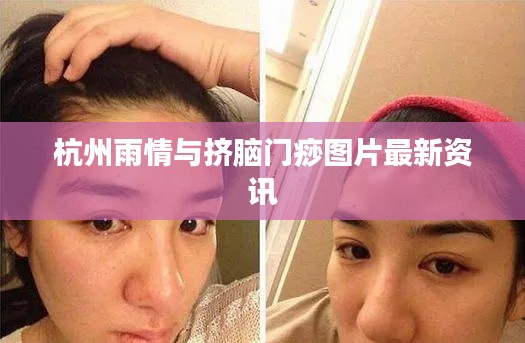 杭州雨情与挤脑门痧图片最新资讯